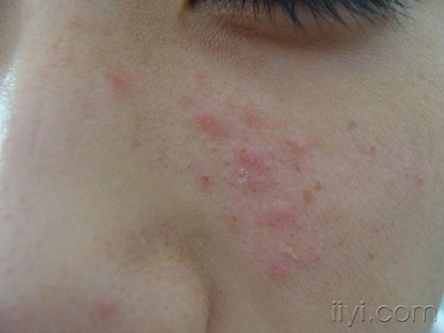 面部丘疹