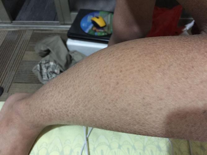 男孩十八岁大腿小腿上有鱼鳞病 求各位用什么药治疗 谢谢