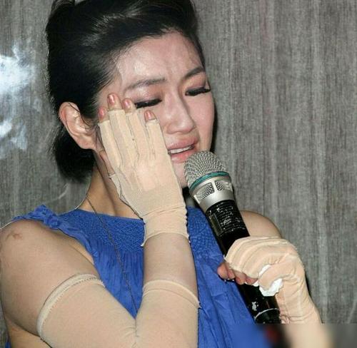 38岁selina:10年前大火54%烧伤近毁容,前夫看疤痕想吐