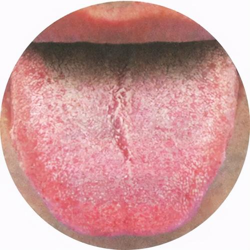 中医养生零基础学舌诊第七讲阴虚体质典型舌象