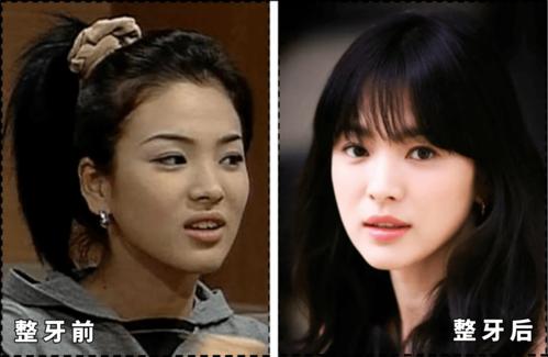 90%的明星都在戴的隐形牙套,能让你的颜值翻几倍