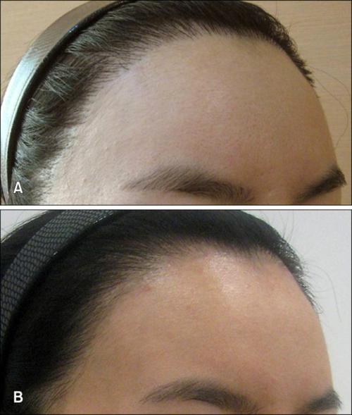 激光在发际线 - 知乎