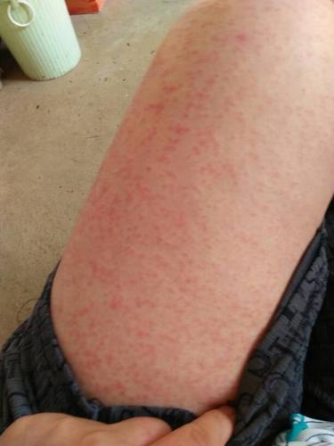 脸上过敏吃中药为什么会引起全身起过敏一样的点点,好