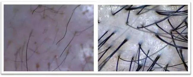 发缝消失了发际线回来了这款澳洲脱发大救星2个月让你发量暴增