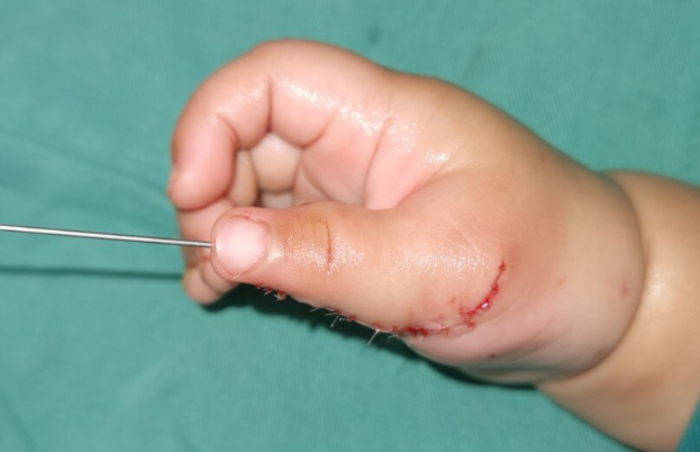 孩子多指手术后多久能恢复?