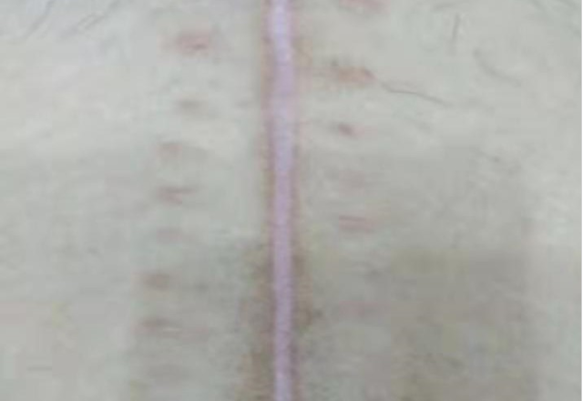 传统开腹手术伤口传统腹腔镜手术伤口单孔腹腔镜手术伤口单孔腹腔镜