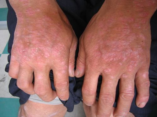 疾病 手癣又称 鹅掌疯,手癣为手掌的皮肤癣菌感染,若仅累及手背,出现