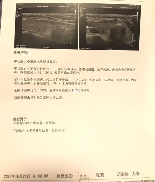 甲状腺_b超_甲状腺结节_协和怎么样_甲状腺癌_医疗健康_医疗健康其他