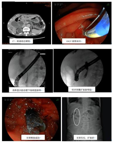 ercp 胆道金属支架置入