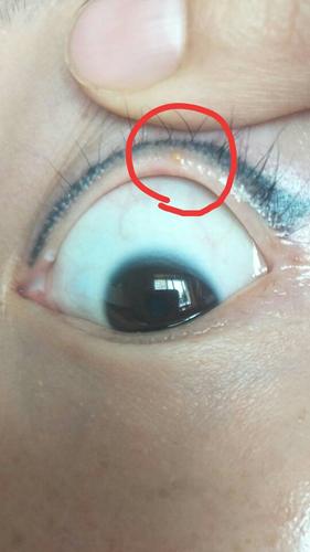 睫毛根部偶尔长小米粒大小水泡(如图)请问什么原因?