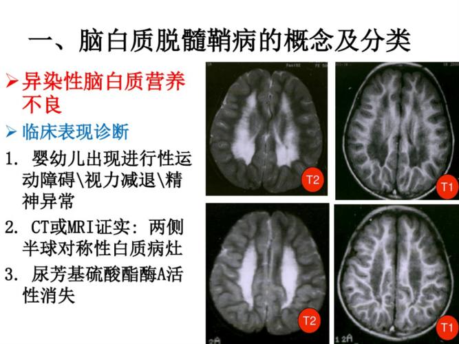 脑白质脱髓鞘疾病.pdf 36页
