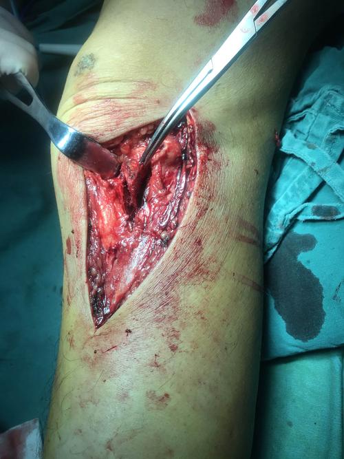 5系统接骨板,手术顺序采取先前外侧解除半月板卡压及外后侧die p