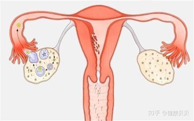 打胎后子宫内膜修复