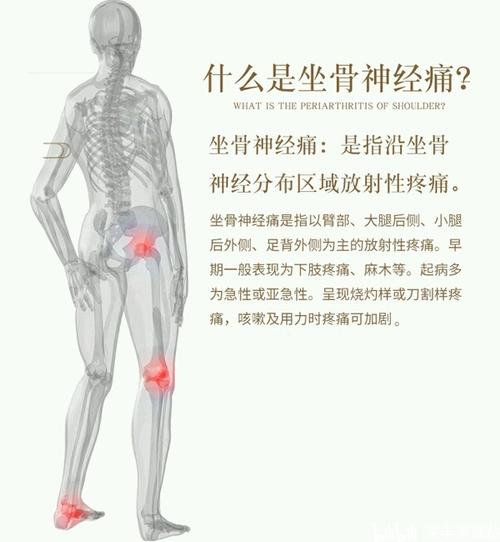 腰椎间盘突出症的典型表现:坐骨神经痛