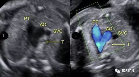 胎儿三血管气管切面重要在哪里?