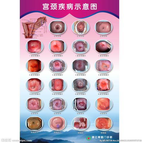 宫颈图片