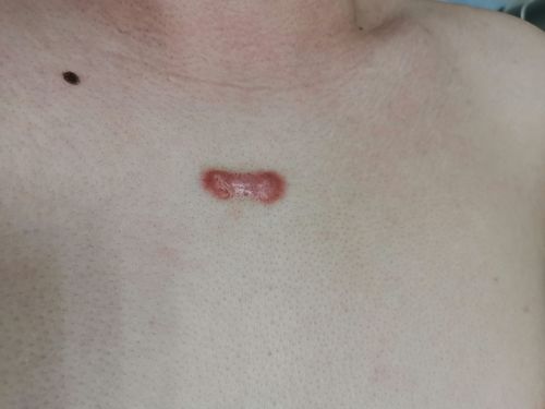 注射疤痕软化针后的注意事项