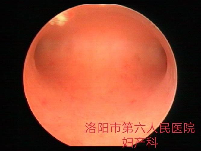 宫腔镜下的正常宫腔形态