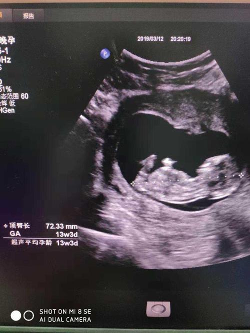 今天晚上去找熟人做了个b超,检测nt,以