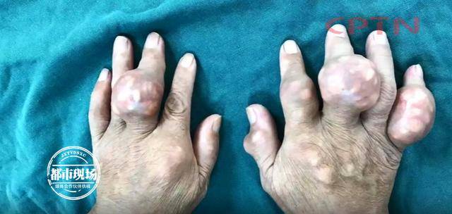 触目惊心男子手上全是囊肿已经严重畸变