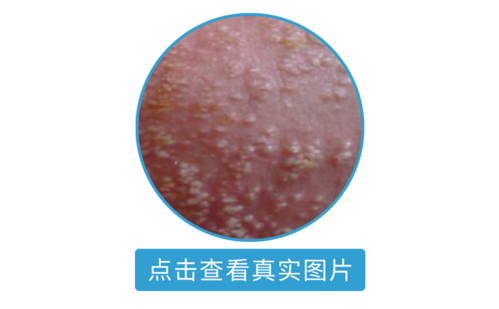 小心「炸蛋」|阴囊湿疹|瘙痒|性病|皮疹|皮肤|-健康界