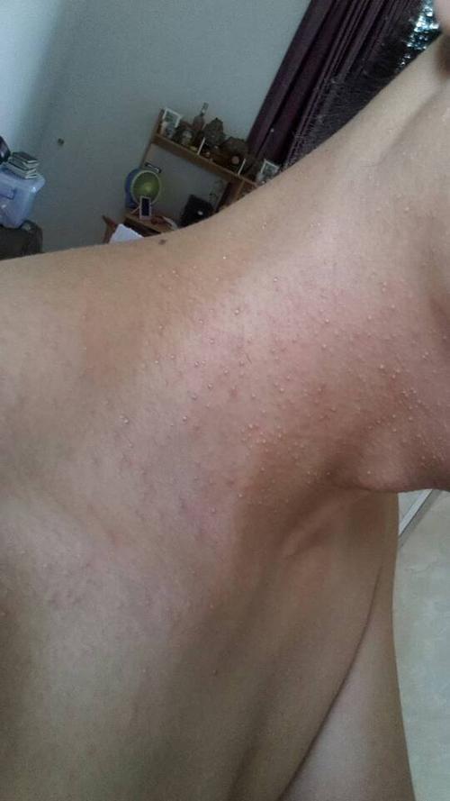 点滴是氯化钠注射液,奥硝唑氯化钠注射液,注射用克林霉素