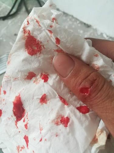 抑郁症又发作了把玻璃用拳头打碎了,真的想死呀,治不好了,哎