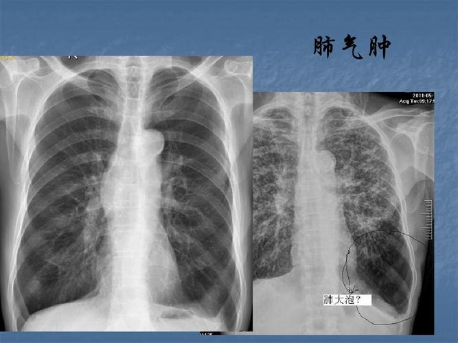 肺部疾病的胸片阅读ppt