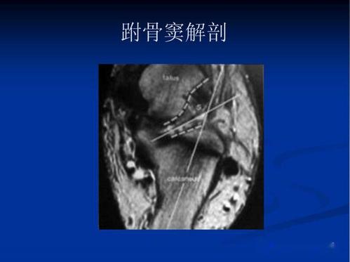 跗骨窦综合征临床与影像