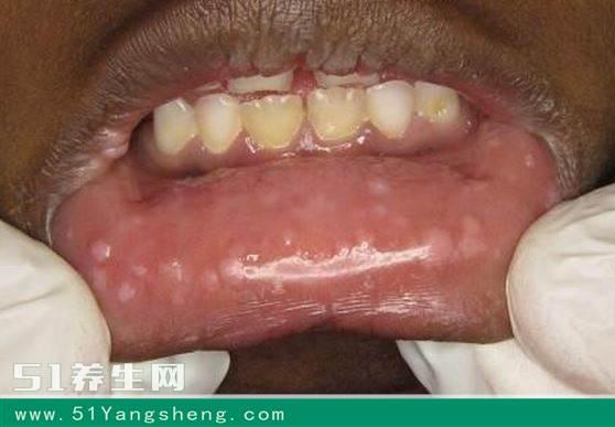 艾滋病通过口腔表现出来?千万别忽视这些可怕症状