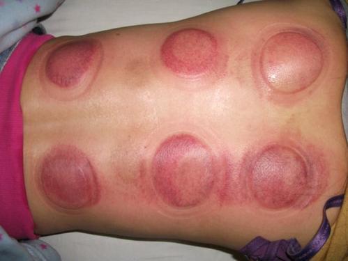 真相在此|拔罐|按摩|刮痧_网易订阅