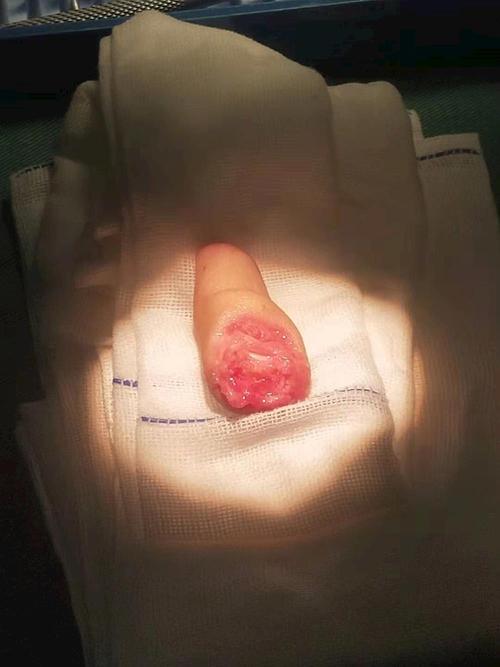 12岁男童断指成功再植,阿拉尔医院再次填补技术空白