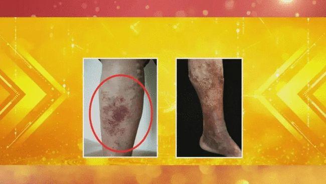 看皮肤,知健康!身上出现这3类红斑,小心背后"藏着病"!