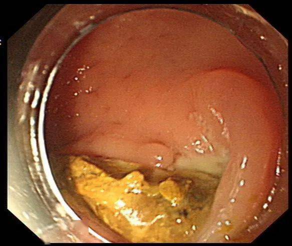 肛门有不明物脱出,竟然是它!