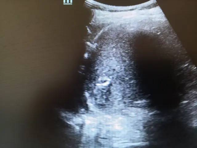 在次看到王女士是1个月后,到医院复查,完全和刚入院时判若两人,漂亮