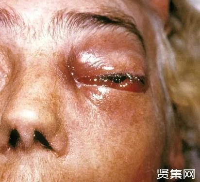 印度毛霉菌感染是怎么引起的,毛霉菌感染能治好吗【毛