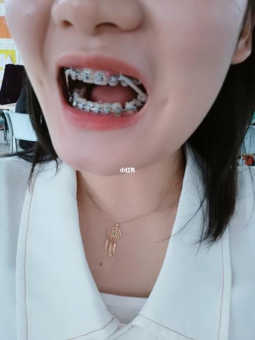 上牙5号托槽掉了,重新粘好了. 2.挂皮筋 没错_皮筋_美妆_医美整形