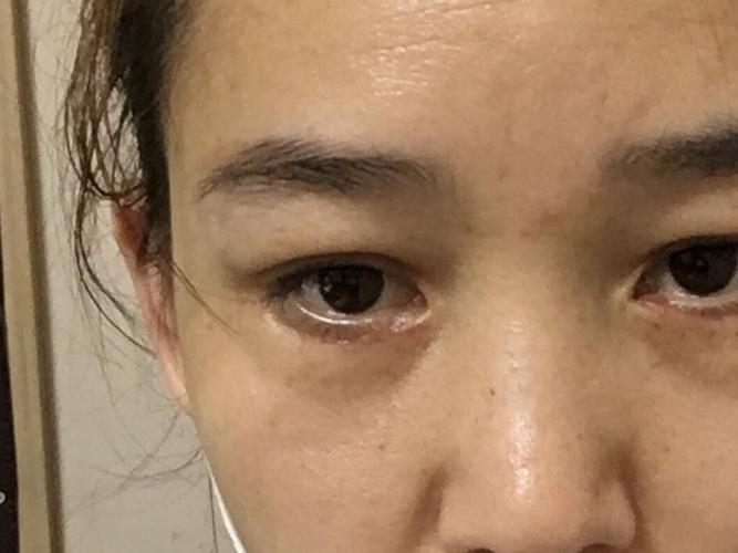 外切眼袋一个月鼓包了怎么回事