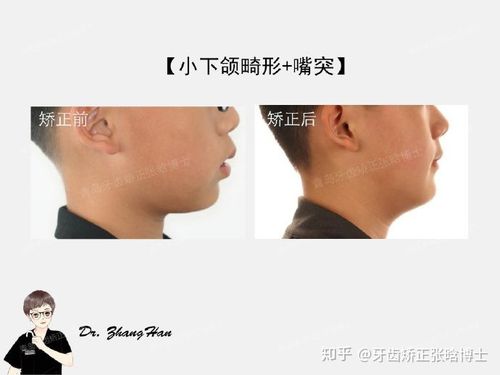 青岛牙齿矫正-张晗-【小下颌畸形 嘴突】正畸案例分享