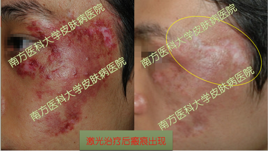 鲜红斑痣鉴别与治疗