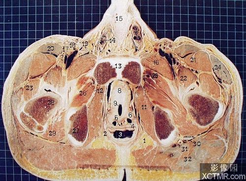 盆部耻骨联合上部层面(男性)轴位断层标本 - 解剖图片
