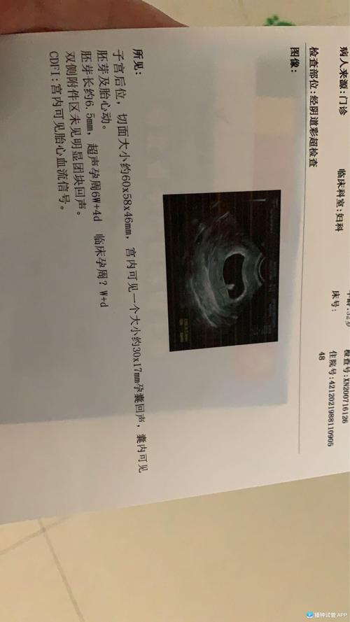 [试管婴儿]移植第30天,成功出现胎心胎芽