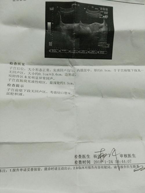推荐回答 2018-01-25 16:08                              子宫憩室