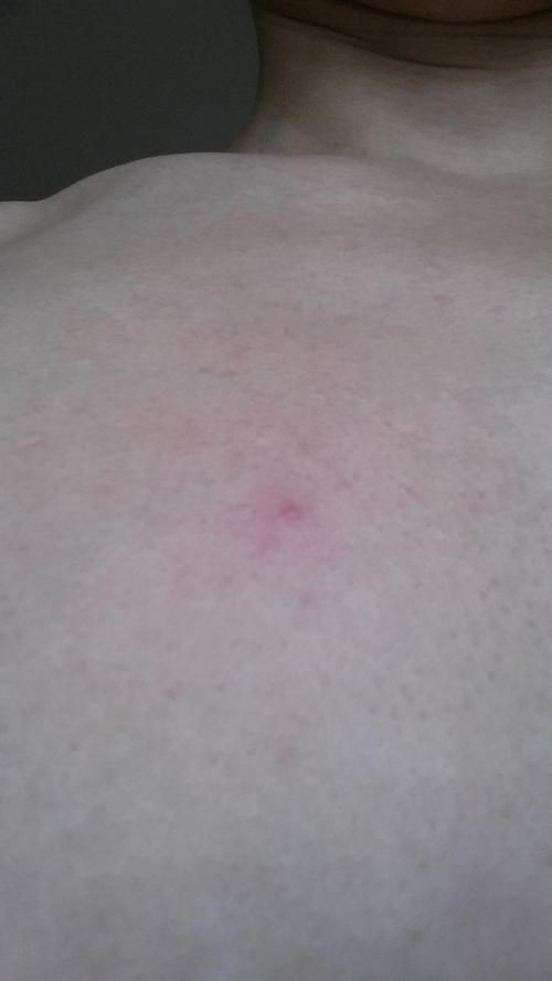 问:请问这是肝掌和蜘蛛痣吗?