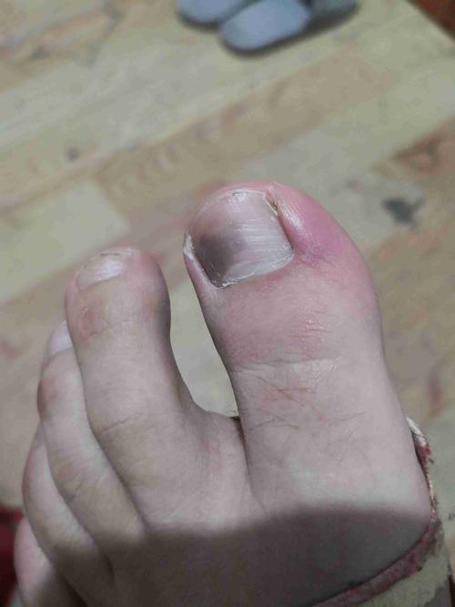 请问一下这个是灰指甲吗,如下图?