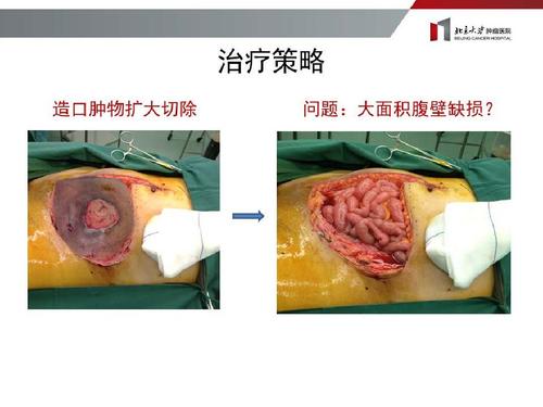 讨论病例--张晓-直肠癌术后造口癌的治疗