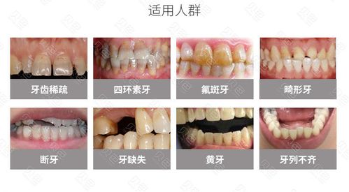 烤瓷牙生物钴铬合金烤瓷牙钴铬合金烤瓷冠牙冠修牙补牙镶牙牙齿修复