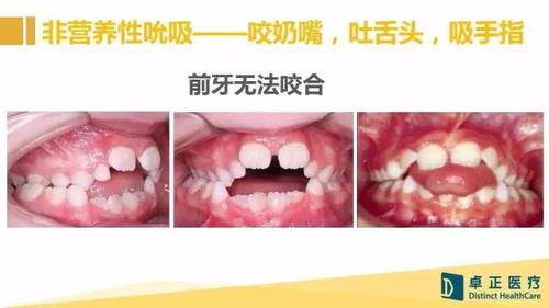 面部畸形的主要原因,最常见的之一是非营养性吮吸,包括使用安抚奶嘴