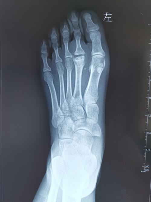 术前左足正位片