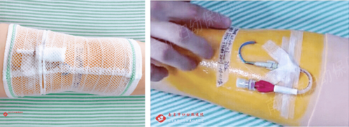 04 用保鲜膜将picc上下10cm缠绕2-3周作为临时袖套,两端用胶布固定